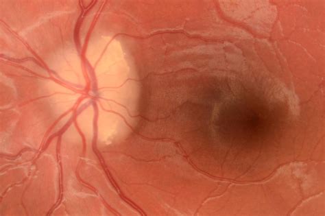 Optic disc drusen and pseudo-papilloedema - eyeonoptics