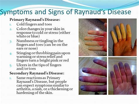 What Is Raynauds Syndrome | Mama Natural