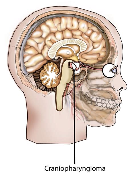 Craniopharyngioma Causes, Symptoms, Diagnoses And Treatment