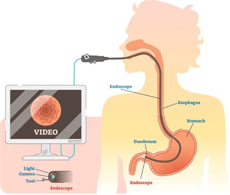 What's the Scope? Spotlight on Endoscopic Ultrasound - Northeast Digestive