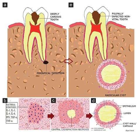 Histology Periapical Cyst