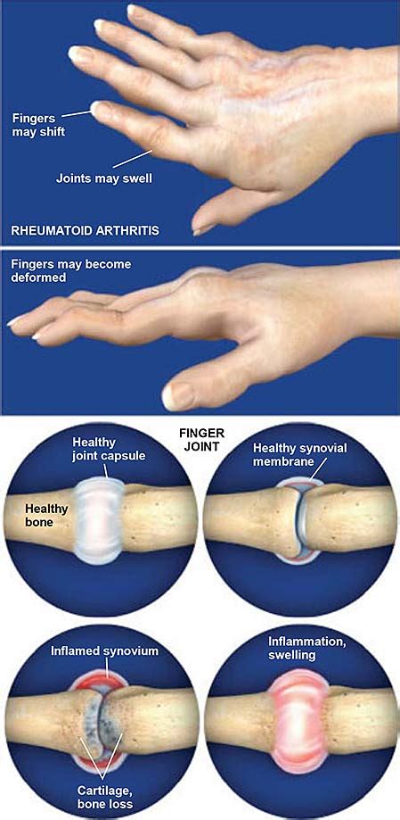 Rheumatoid Arthritis (RA) of the Hand | Central Coast Orthopedic ...