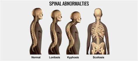 Lordosis Is A Common Treatable Condition in Kids & Adults