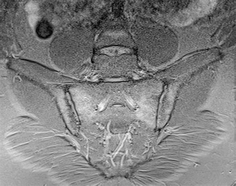 MRI Indicates Sacroiliitis in Some Healthy Individuals