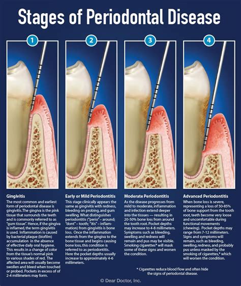 What are the stages of gum disease? – Britten Perio