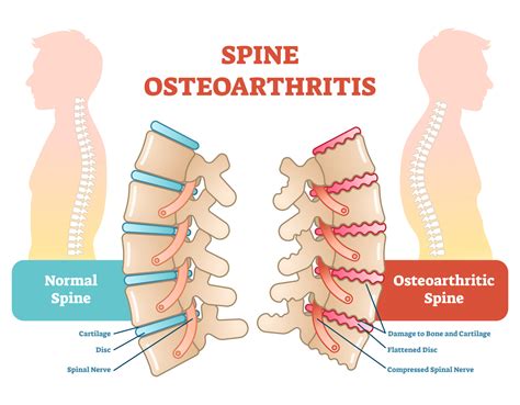 What is Osteoarthritis, and How Does it Affect My Spine?