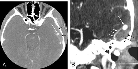 Spontaneous Resolution of Posttraumatic Middle Meningeal Artery ...