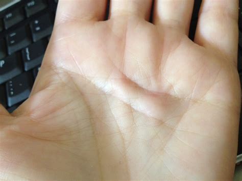 MARIETTE'S BACK TO BASICS: {My Hand and Dupuytren's Contracture}