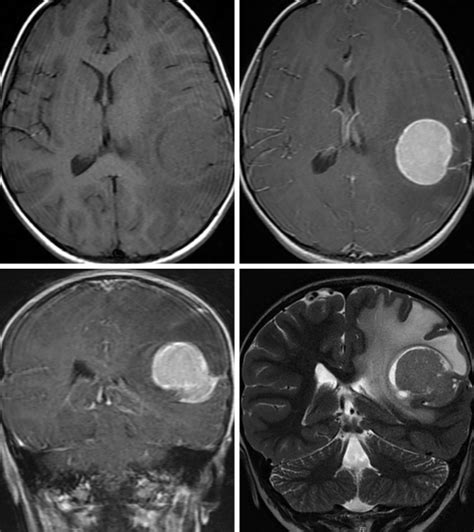 Pleomorphic Xanthoastrocytoma (PXA) | The Neurosurgical Atlas, by Aaron ...