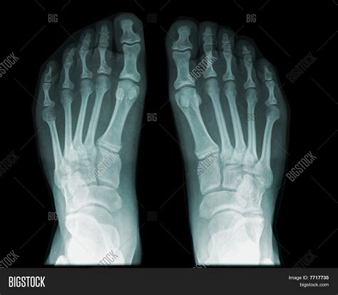 Human Foot /feet On X-ray Image & Photo | Bigstock