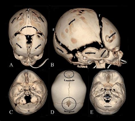 Neural Exam - Newborn head shape and sutures - Embryology