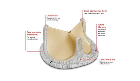 Surgical aortic pericardial valves | Edwards Lifesciences | Valve ...