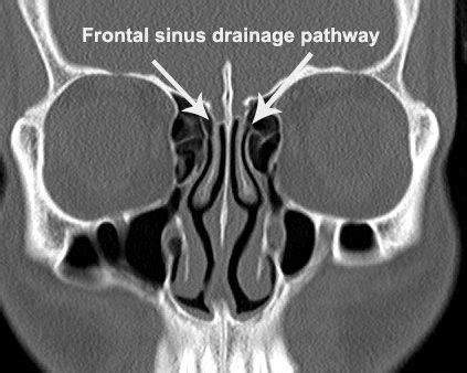 Why do I need a CT scan for my sinuses? - Dr Dharambir S Sethi