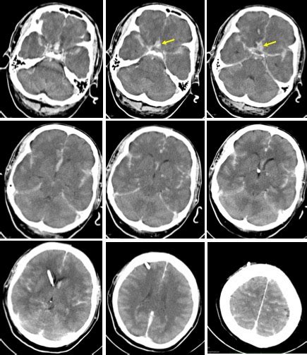 ACOM aneurysms – Radiology Cases