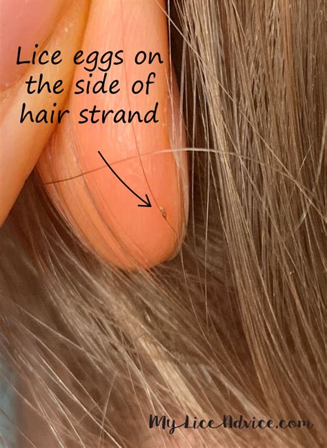 Pictures of What Lice Eggs (Nits) Look Like in Hair: 9 Tips to Spot Them