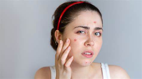 How to Treat Acne - Upstate Physicians