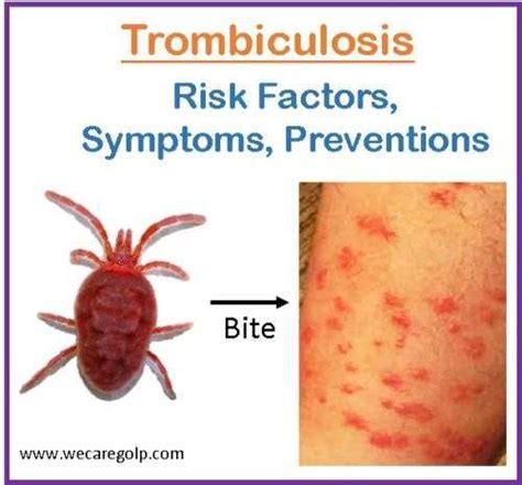 Trombiculosis (Chigger Infestation) - We Care