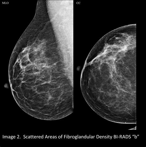 Your patient got a dense breast notification with her mammogram report ...