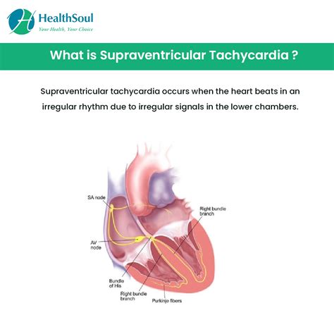 Supraventricular Tachycardia: Causes, Symptoms and Treatment – Healthsoul