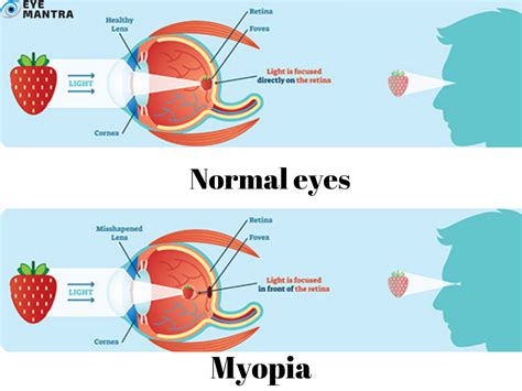 Myopia: Symptoms, Causes and Treatment | Eyemantra