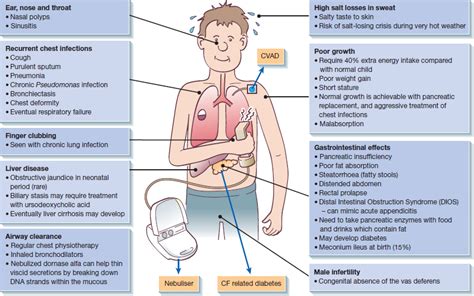 Cystic fibrosis management | Nurse Key