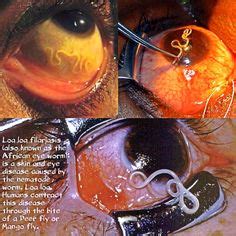 11 Loa loa ideas | eye worm, parasite, worms