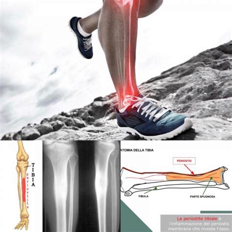 TIBIAL PERIOSTITIS - Arduua