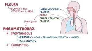 The Most Critical Treatment for a Tension Pneumothorax Involves