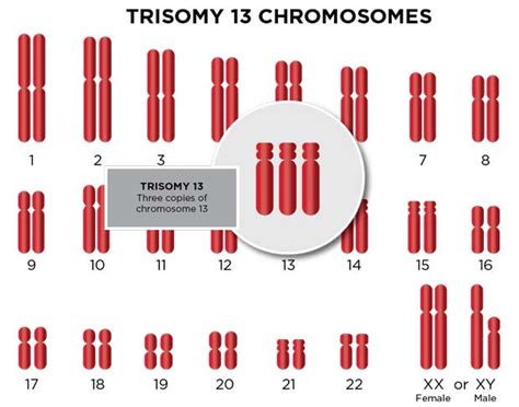 Trisomy 13 (Patau Syndrome): Types & Diagnosis