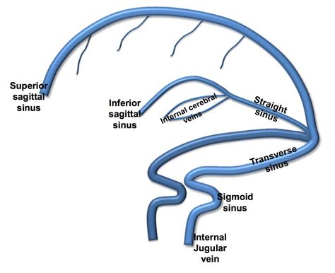 Sigmoid Sinus