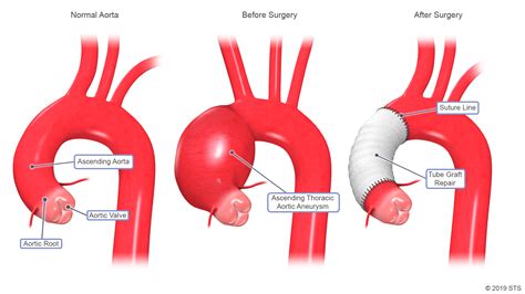 Thoracic Aortic Aneurysm | The Patient Guide to Heart, Lung, and ...