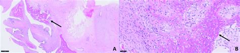 (A) Histopathology of the tumour in the resected mastectomy specimen at ...