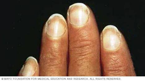 Slide show: 7 fingernail problems not to ignore - Mayo Clinic