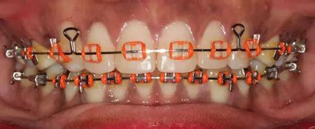 Braces Colours - Show off your personality with colour!