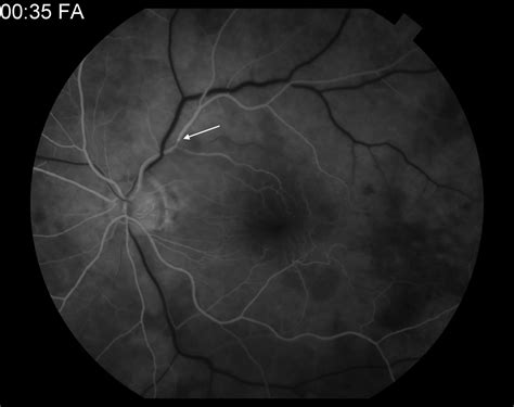 Moran CORE | Fundus Photography and Fluorescein Angiography of Branch ...