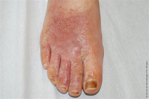 Dermatitis On Feet