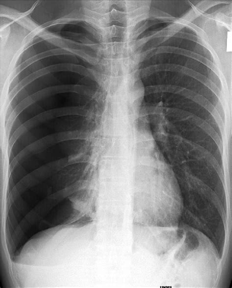 Tension pneumothorax -chest X -ray | Download Scientific Diagram