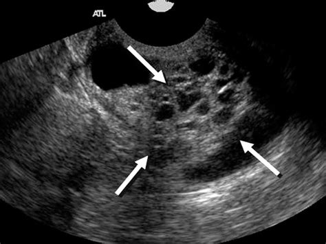 Nabothian Cyst In Cervix Ultrasound