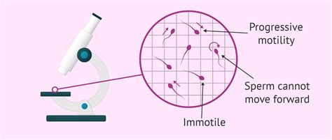 What is asthenozoospermia? - definition, causes and treatment