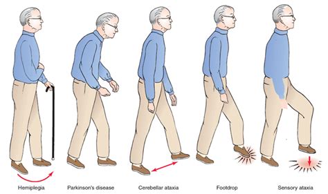 USMLE Review.Hemiplegic Gait: The patient stands with unilateral ...