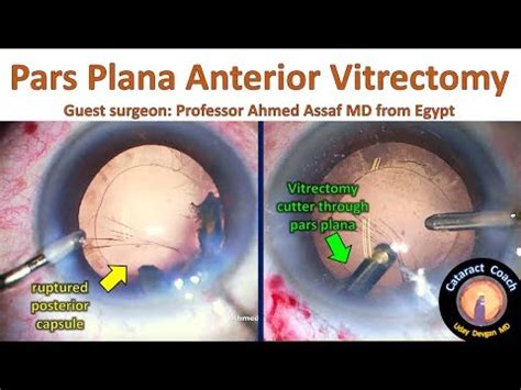 Pars Plana Anatomy