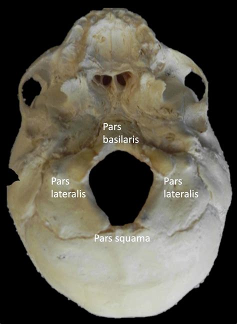 Cureus | Foramen Magnum Variant With Elongation of the Anterior Notch