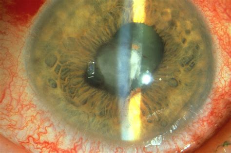 Sarcoid Anterior Uveitis | Wills Eye Hospital