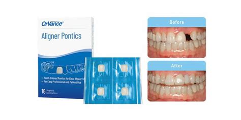 OrVance Launches Aligner Pontic Solution for Patient Use | Orthodontic ...