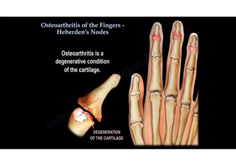 Finger Joint Arthritis Pain at Benjamin Prim blog