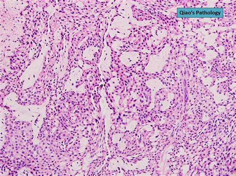 Qiao's Pathology: Glomus Tumor | Microscopic photo showing t… | Flickr