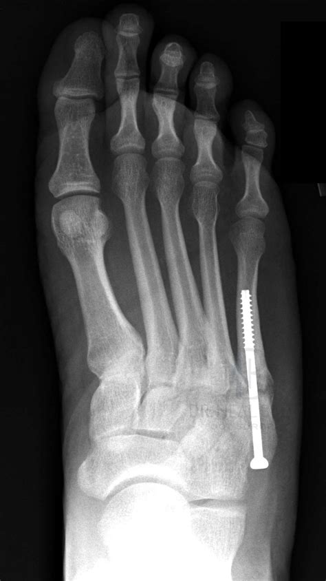 4 Types of Fifth Metatarsal Fracture