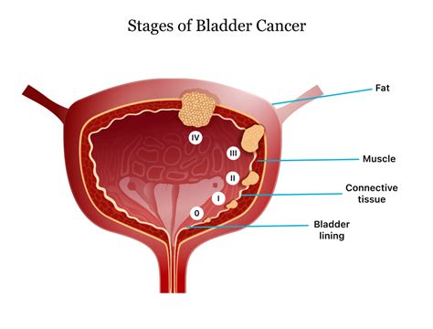 Comprehensive Bladder Cancer Guide: Symptoms, Treatments, and Risks