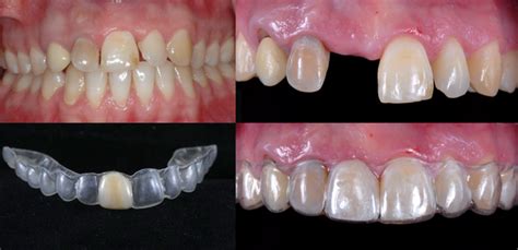 Learn how to use and fabricate Zendura pontic retainer. - ZenduraDental