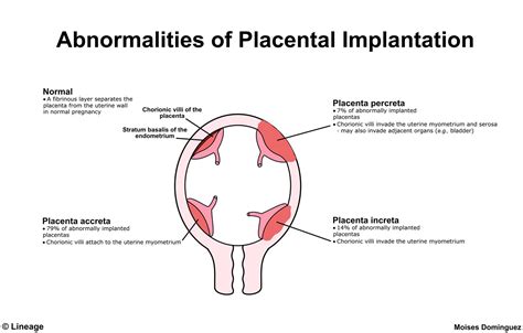 Placenta Accreta - Obstetrics - Medbullets Step 2/3